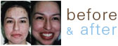 Before and After Acne